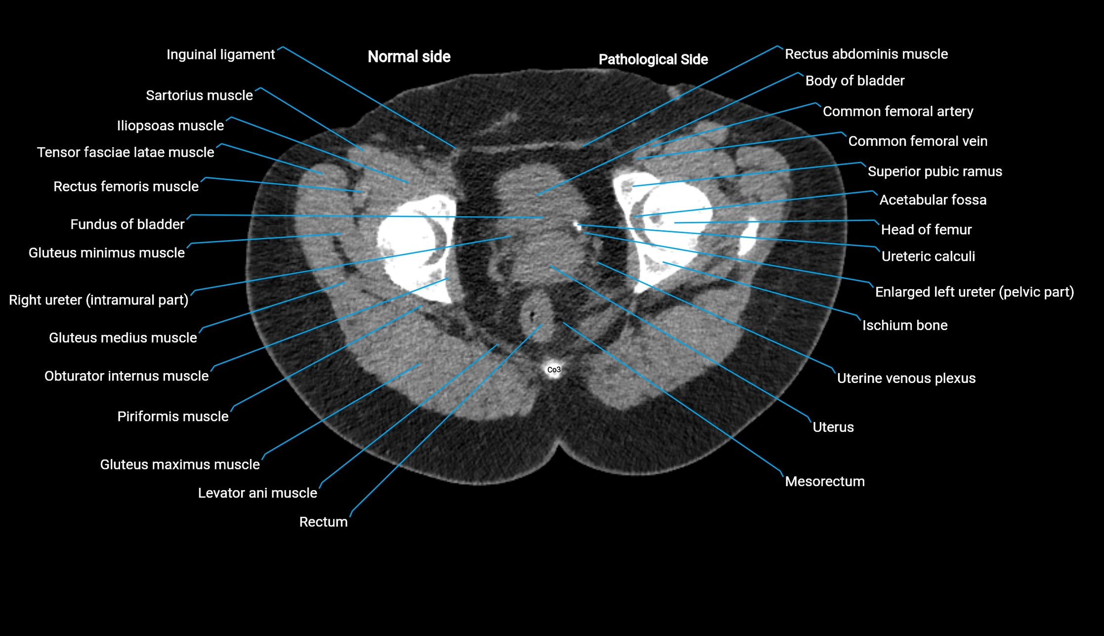 CT KUB axial cross sectional anatomy  radiology image -img-00201-00158.webp